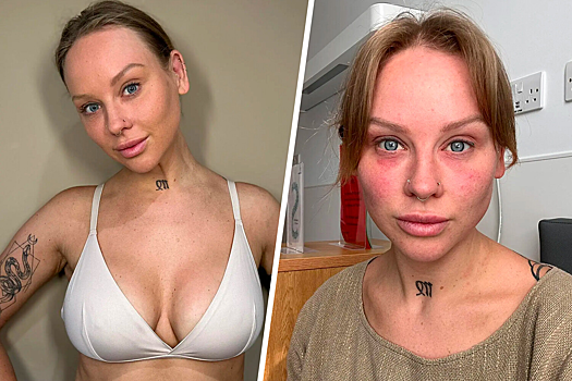 Модель заявила, что ослепла из-за грудных имплантов