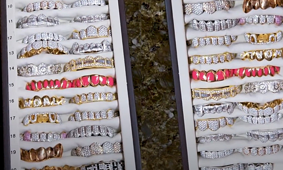 Стоматолог-ортодонт: грилзы могут ухудшить прикус